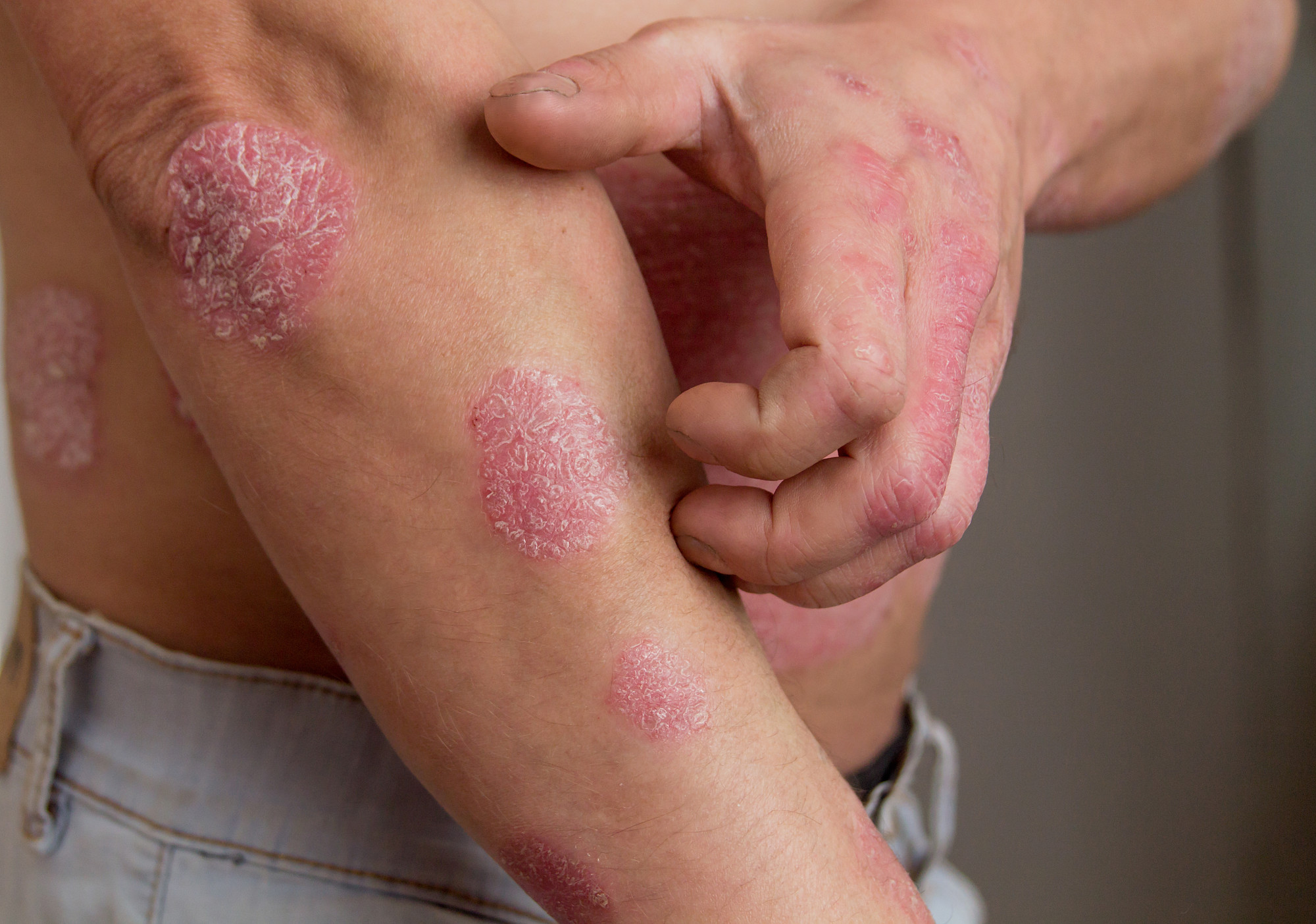 Ayurvedic Treatment For Eczema How Does It Work
