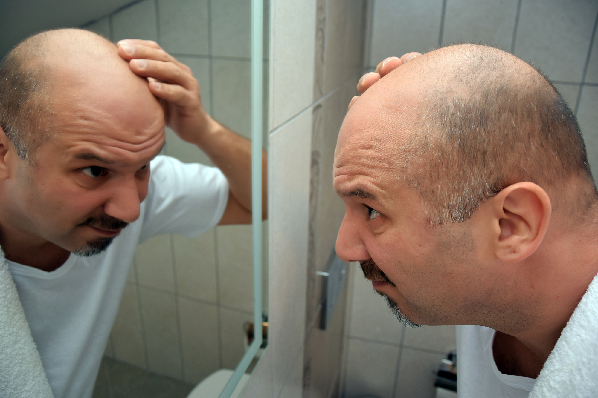 hair loss