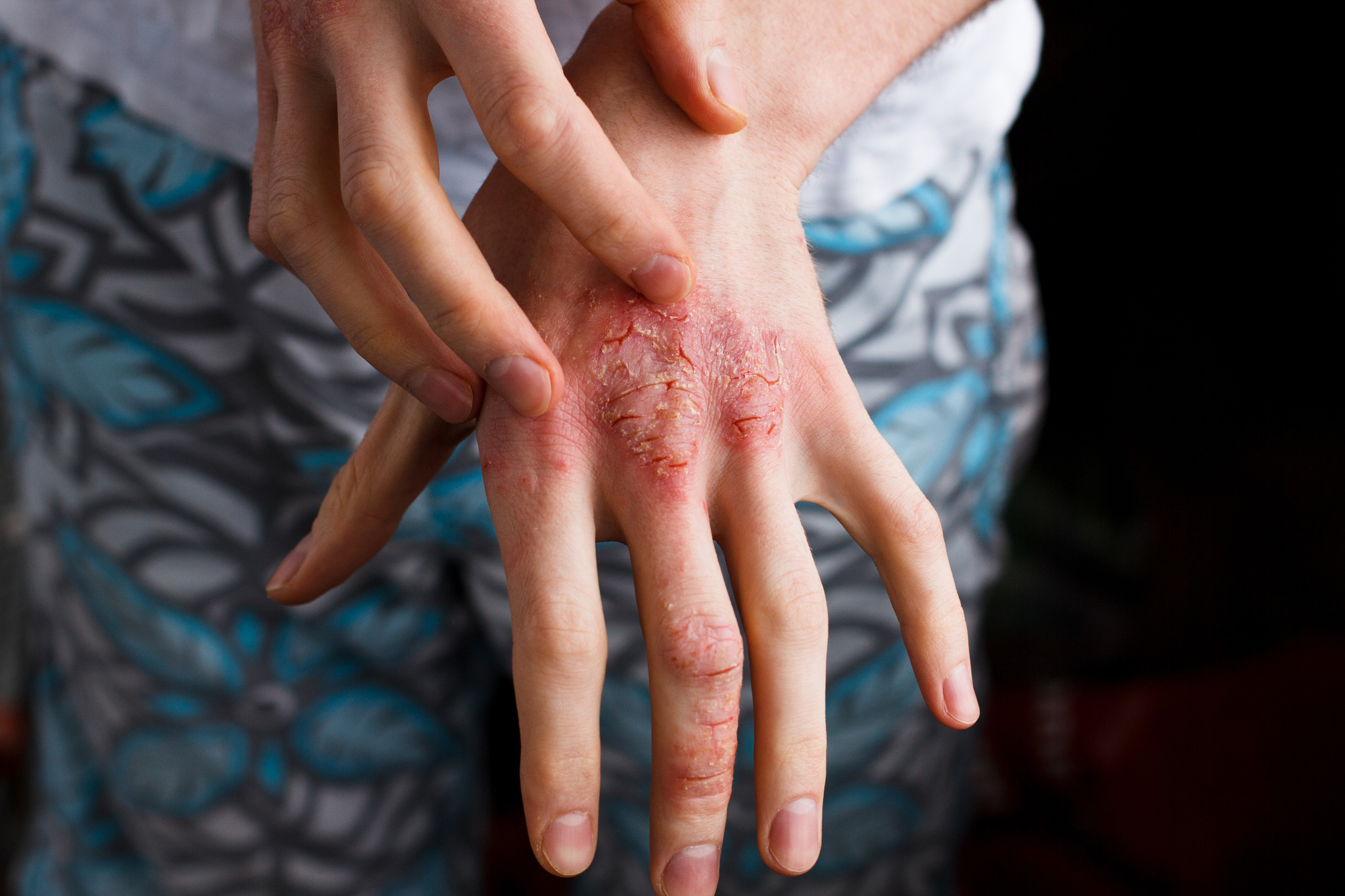 Ayurveda eczema treatment